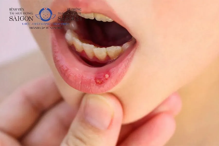 Nhiệt miệng có thể khởi phát dưới dạng mụn nước không đau