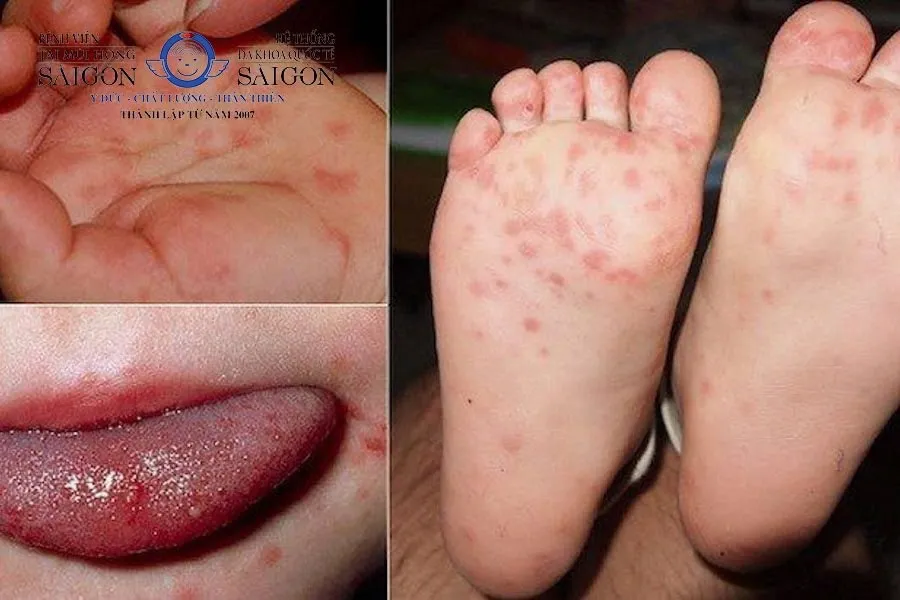 Trẻ em bị tay chân miệng với mụn nước lan rộng trong miệng và trên cơ thể