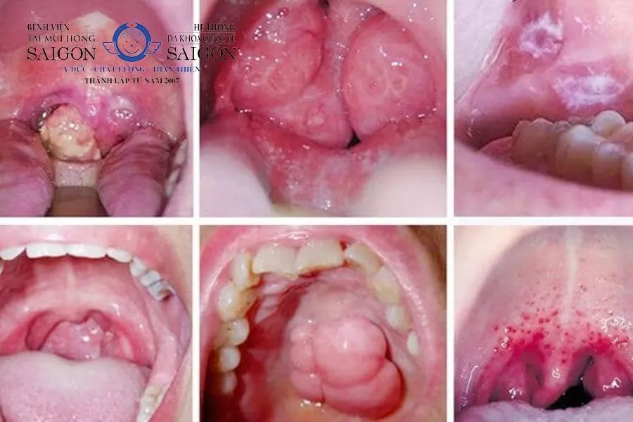 Mụn nước kéo dài, bất thường có thể là dấu hiệu cảnh báo ung thư khoang miệng