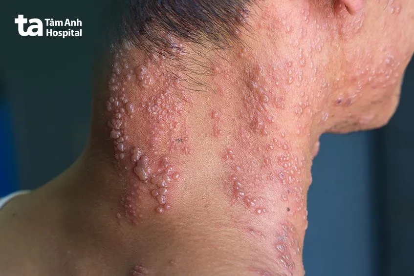 các thể bệnh zona thường gặp